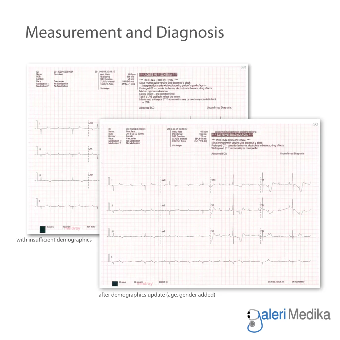 Mindray BeneHeart R12 Electrocardiograph ECG Machine 12-Lead Mindray BeneHeart R12 Electrocardiograph ECG Machine 12-Lead
