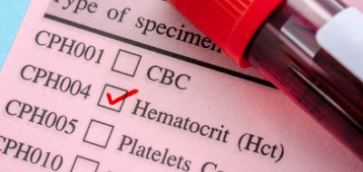 Kenali Hematokrit Yang Sama Pentingnya Dengan Gula Darah
