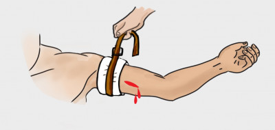 Pedoman Cara Menggunakan Tourniquet Yang Baik Dan Benar