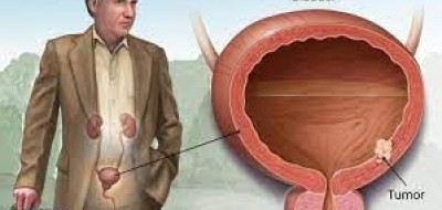 Mengenal Kantong Urostomy Tindakan Pasca Operasi Kanker Kandung Kemih