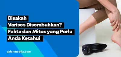 Bisakah Varises Disembuhkan? Fakta dan Mitos yang Perlu Kamu Ketahui