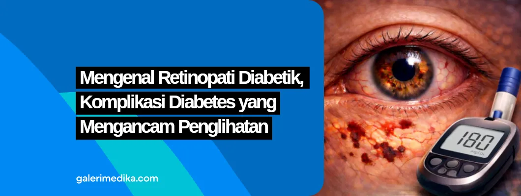 Mengenal Retinopati Diabetik, Komplikasi Diabetes yang Mengancam Penglihatan