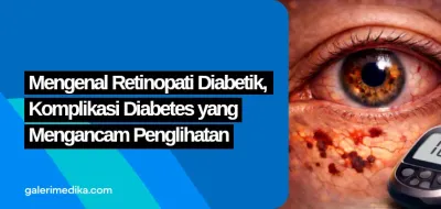 Mengenal Retinopati Diabetik, Komplikasi Diabetes yang Mengancam Penglihatan
