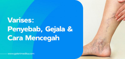Penyebab Varises Pada Kaki dan Bagaimana Cara Mengobati