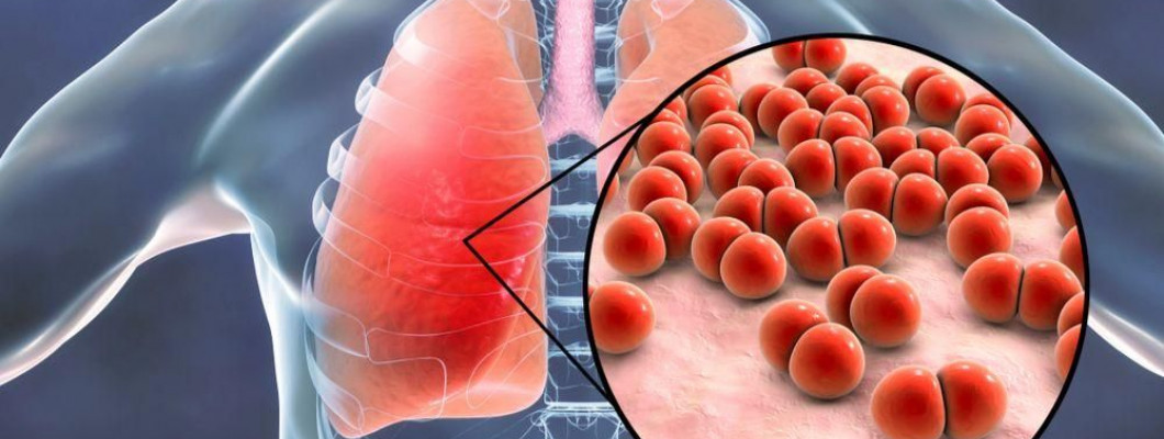 Pneumonia, Penyakit yang Berbahaya Jika Tidak Segera Ditangani