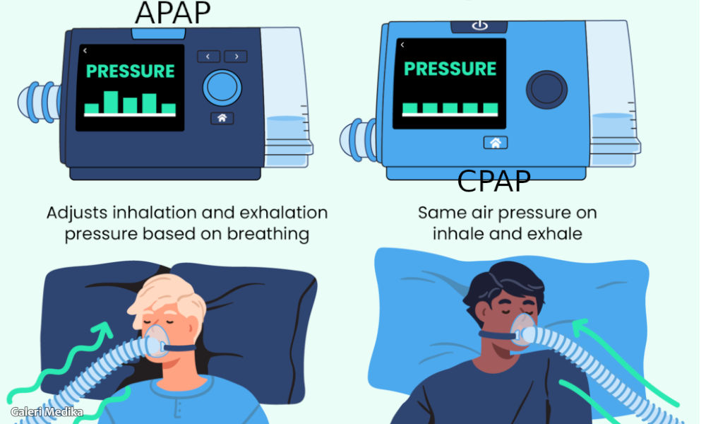 APAP vs CPAP, Lebih Cocok Mana untuk Penderita Sleep Apnea?