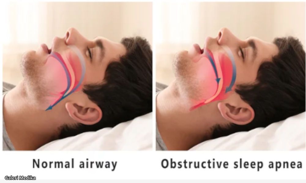 Review ResMed AirSense 10 Auto CPAP untuk Sleep Apnea