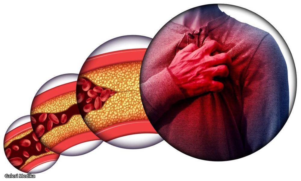 Benarkah Tekanan Darah Jadi Pertanda Serangan Jantung?