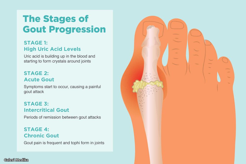 gejala asam urat dan bagaimana cara mengobati