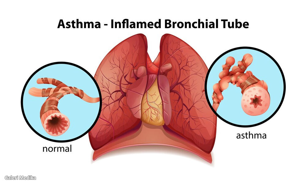 Pengobatan Asma untuk Anak: Anjuran dan Larangan