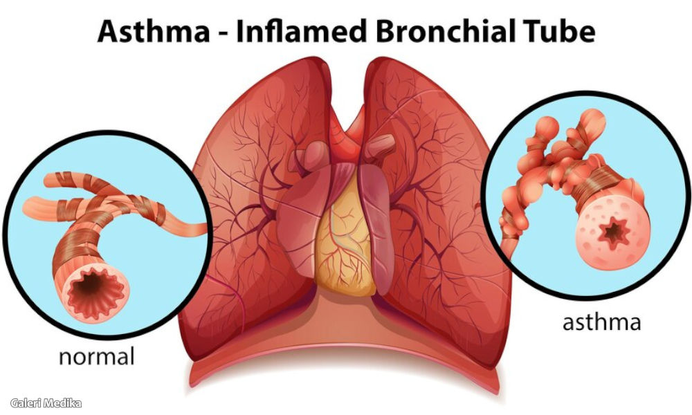 Tips Menjalani Pola Hidup Normal Bagi Penderita Asma
