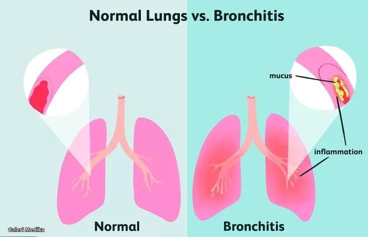 Kenali Penyebab Bronkitis dan Cara Mencegahnya
