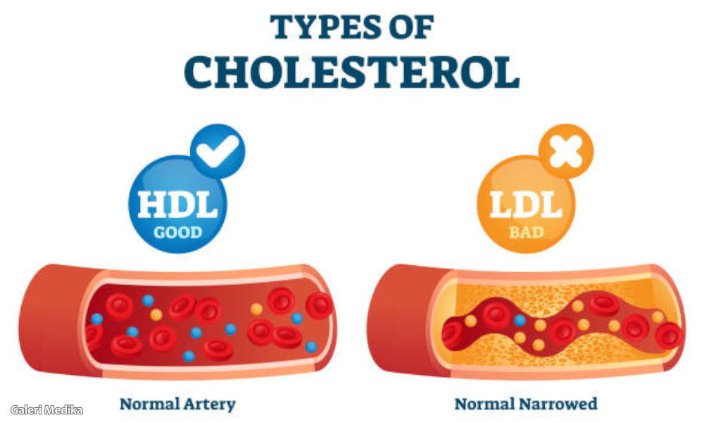 Perbedaan HDL, LDL, dan Trigliserida