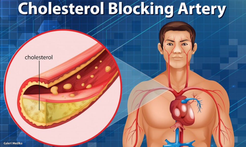 Jenis Susu Apa yang Terbaik Bagi Seseorang dengan Kolesterol Tinggi?