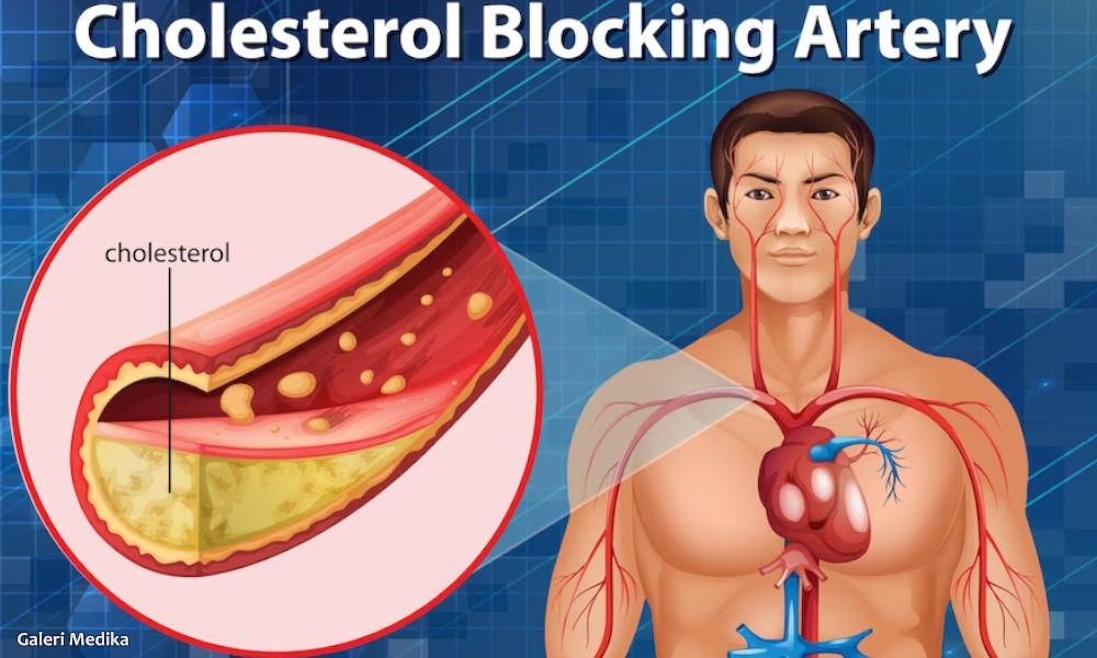 Seberapa Penting Tes Profil Lipid untuk Penderita Kolesterol?