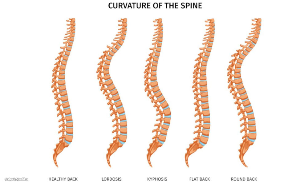 Lordosis: Penyebab, Gejala dan Cara Mengobati
