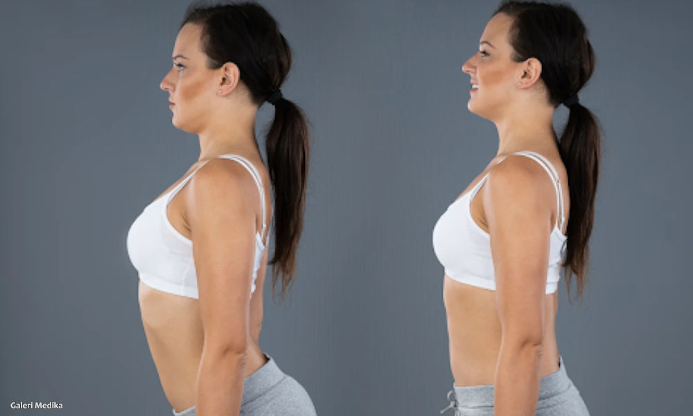 Lordosis: Penyebab, Gejala dan Cara Mengobati