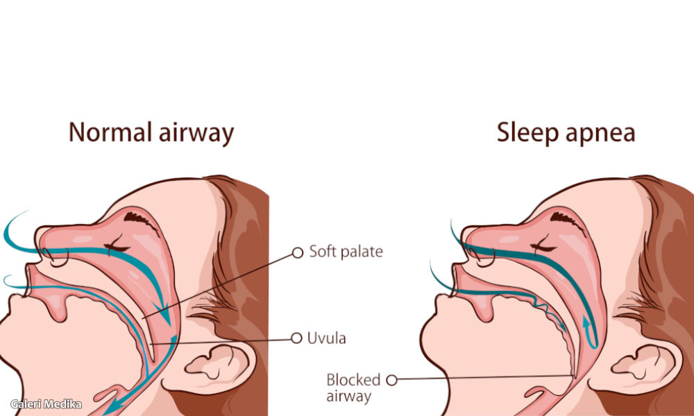 Perbedaan Obstruktif Sleep Apnea dan Central Sleep Apnea