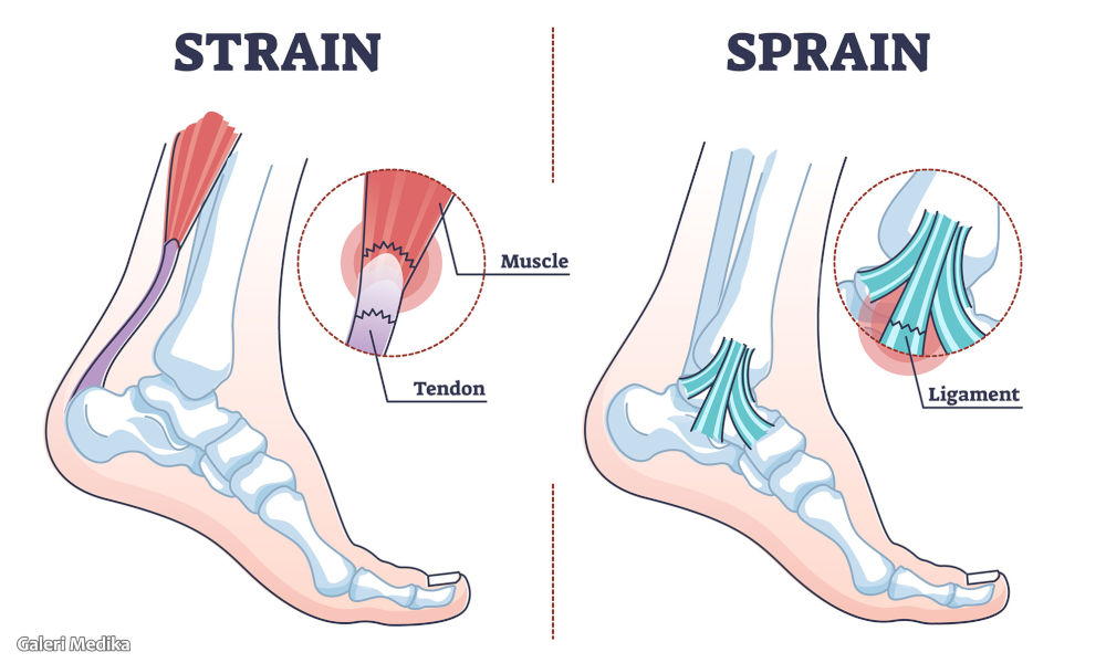 Sprain dan Strain: Gejala, Penyebab, dan Cara Mengobatinya