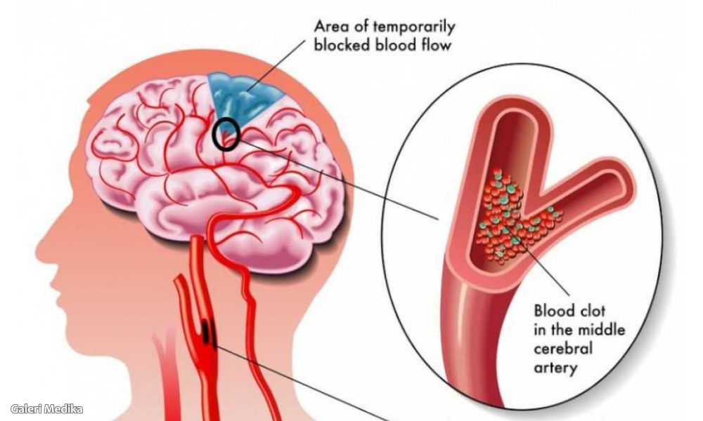 7 Tips Melindungi Diri Terhadap Stroke