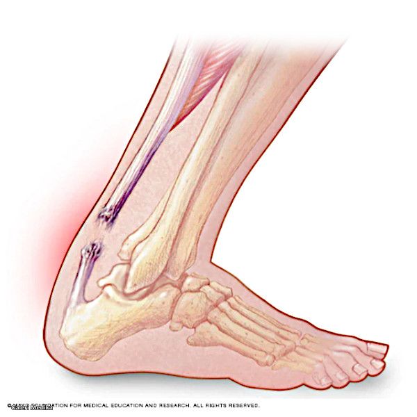 penyebab ruptur tendon achilles