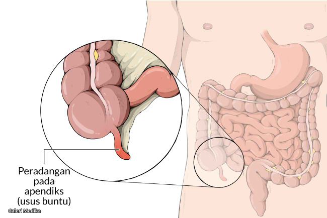 Apakah Benar Konsumsi Mie Instan Menyebabkan Usus Buntu?