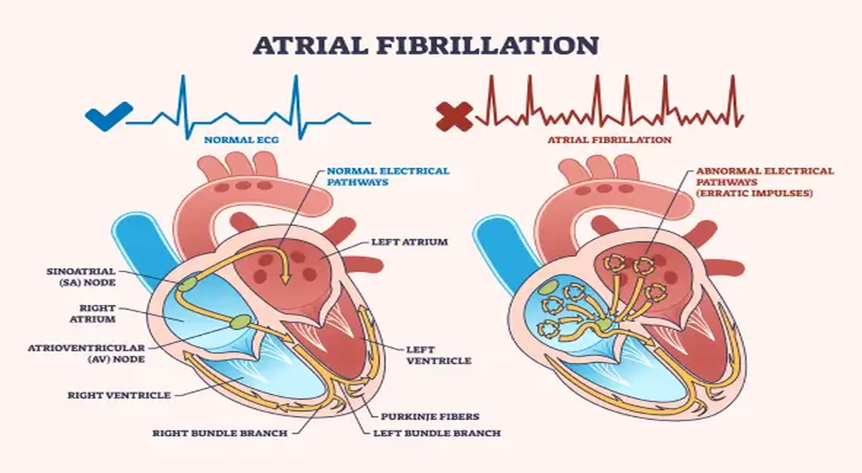 afib