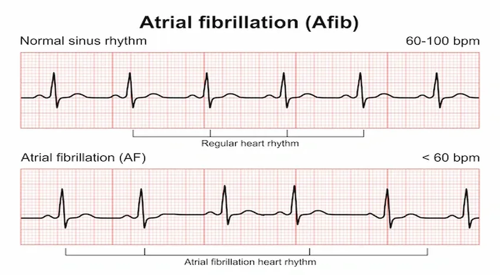 afib