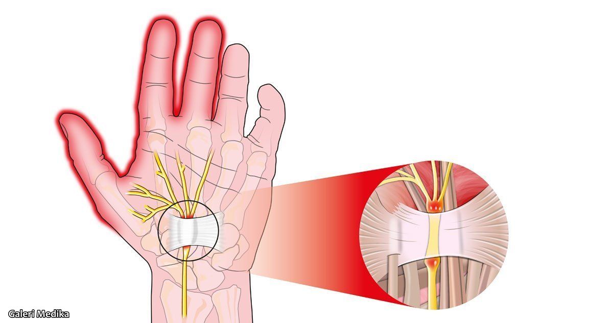 carpal tunnel syndrome