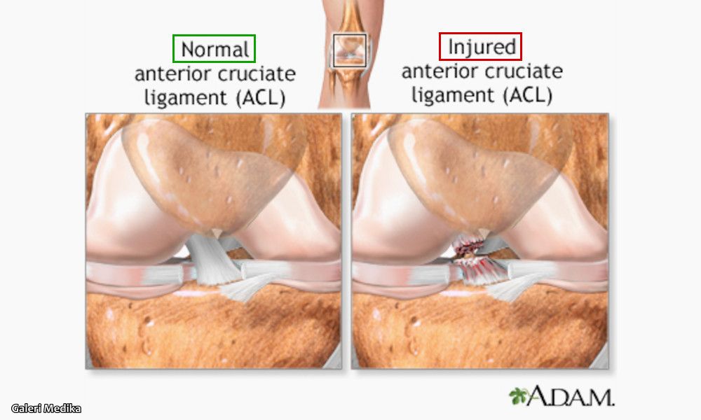 penyebab cedera acl