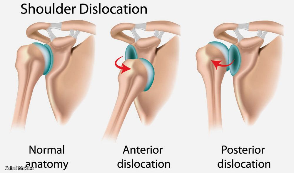 Penyebab Dislokasi dan Bagaimana Cara Mengobati