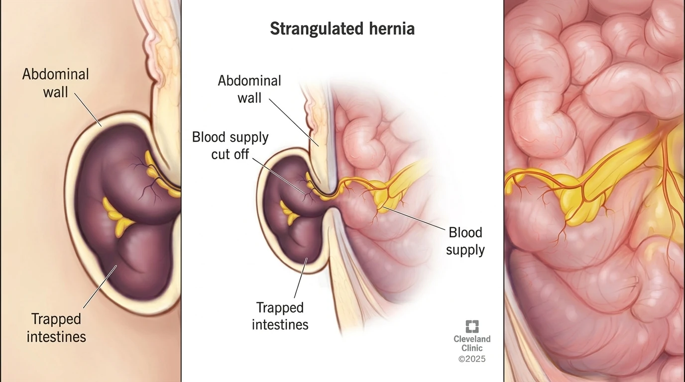 hernia