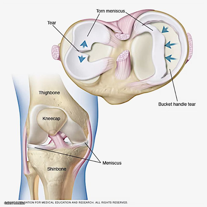 penyebab cedera meniskus
