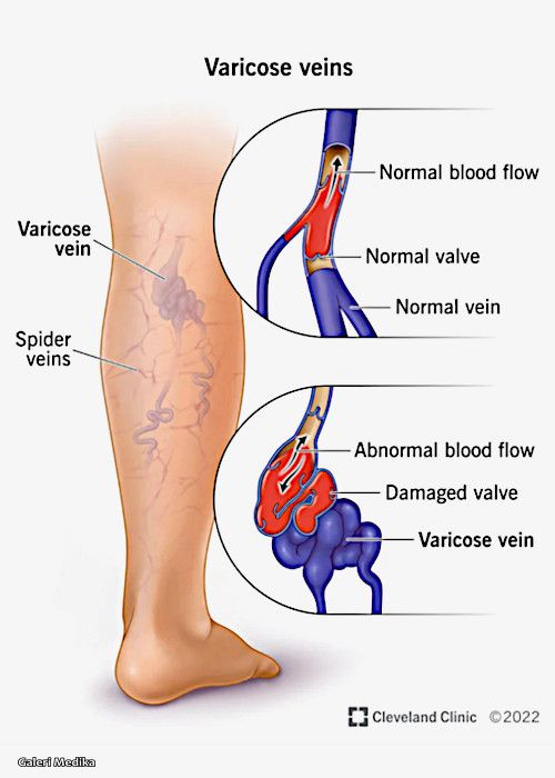 penyebab varises dan bagaimana cara mengobati