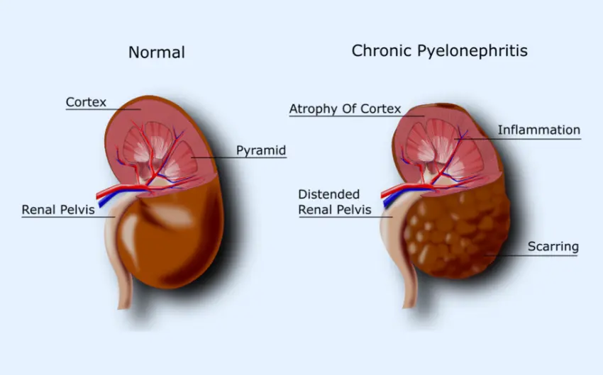 gagal ginjal kini mengintai anak muda