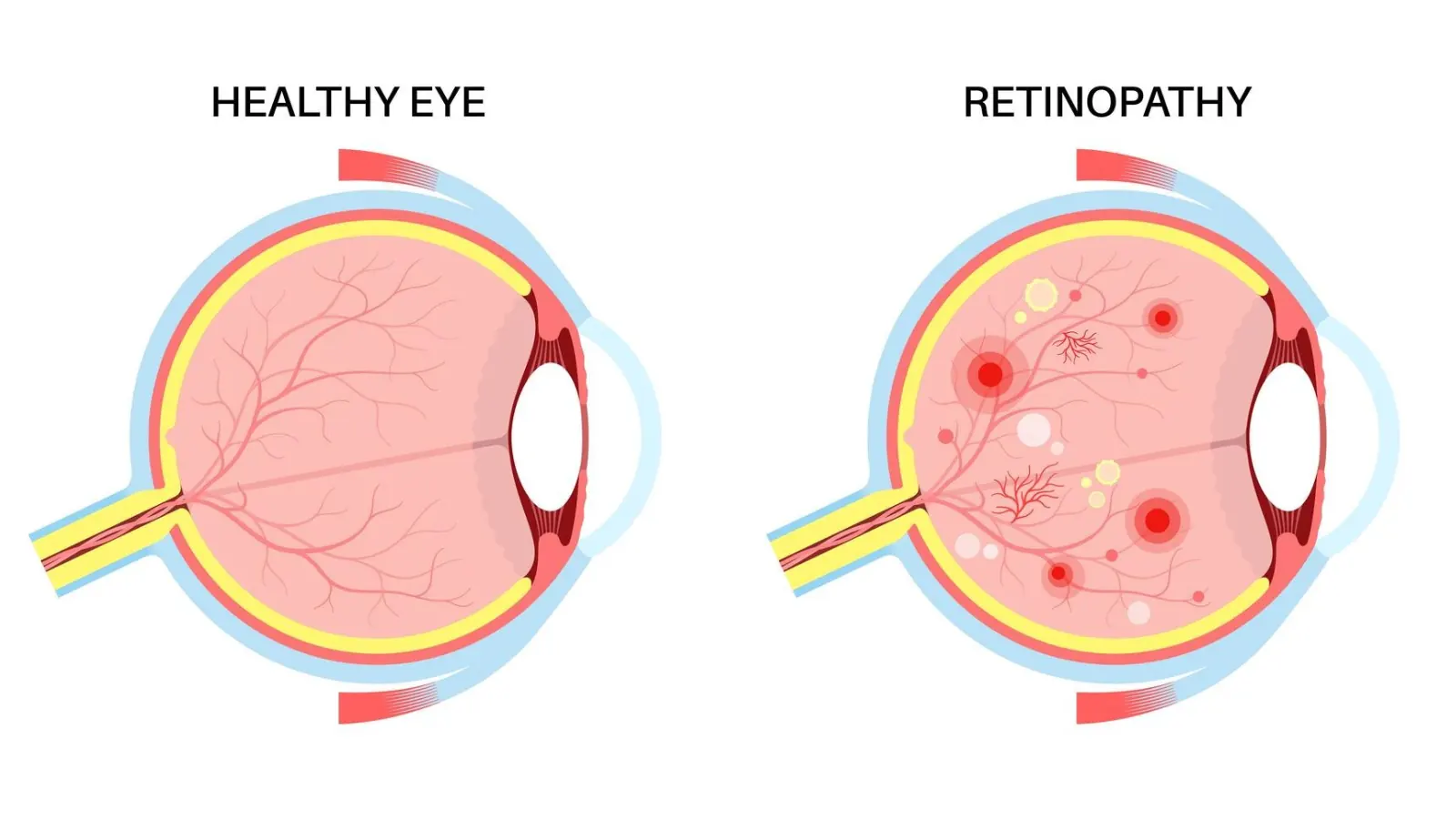 Retinopati Diabetik