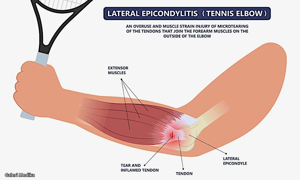 Penyebab Tennis Elbow dan Bagaimana Cara Mengobati