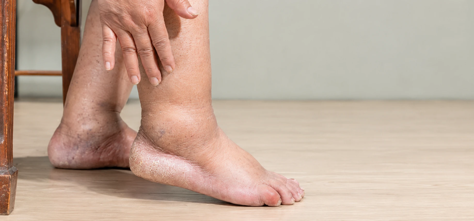 lymphedema