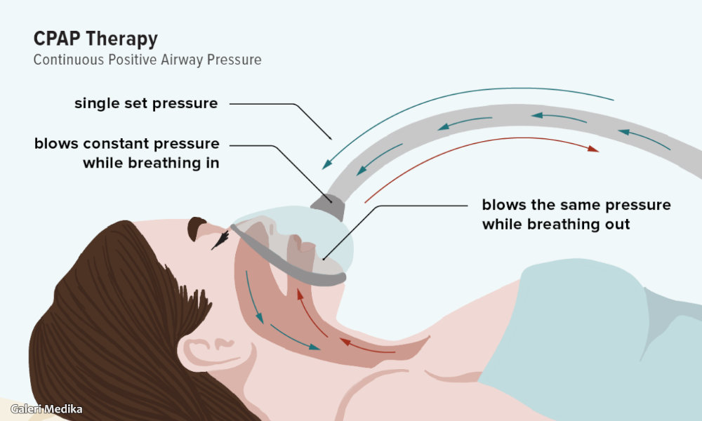 bagaimana cara kerja alat terapi cpap