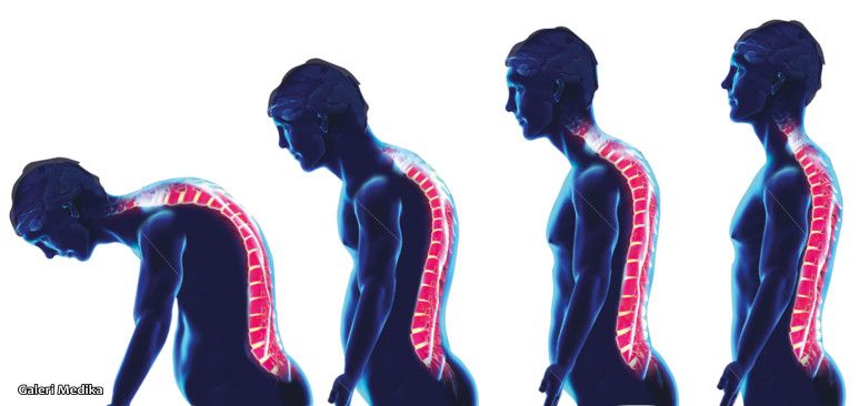 Tips Memperbaiki Postur Tubuh