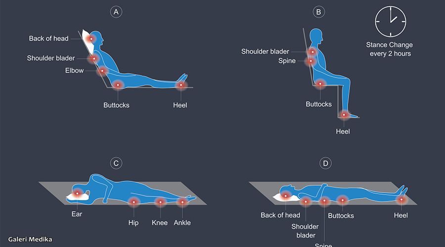 cara pakai kasur anti decubitus