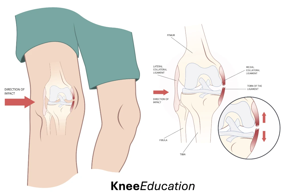 Neymar Jr. Sampai Cristiano Ronaldo Pernah Kena! Begini Bedanya Cedera ACL, MCL, dan Meniskus