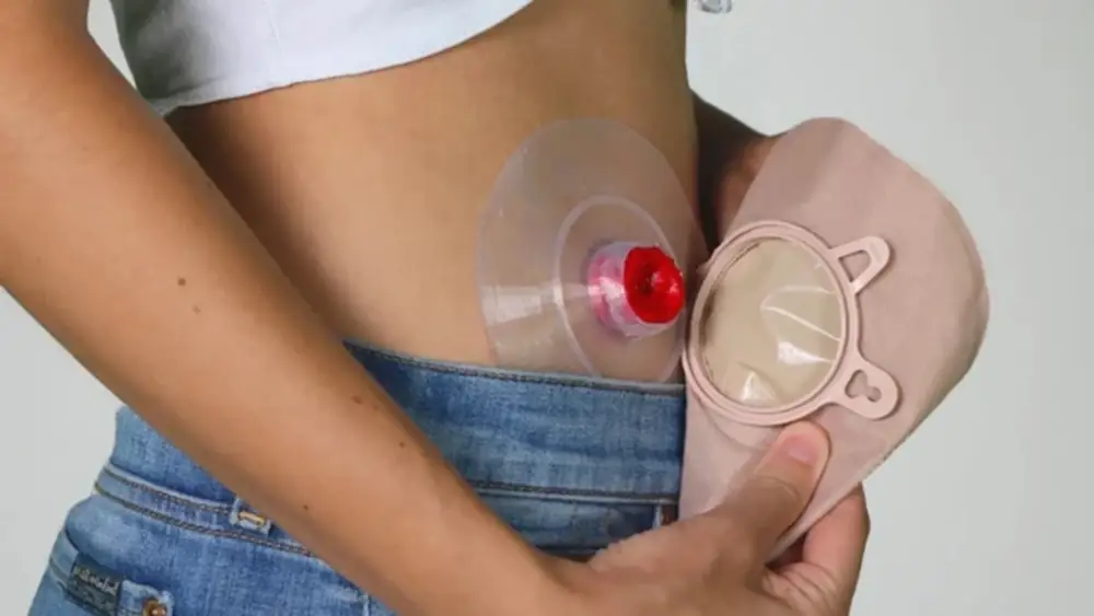 Pernah Dengar Kantung kolostomi? Bukan Sekadar Kantong, Kenali Fakta, Peran dan Jenis Yang Perlu Kamu Tahu