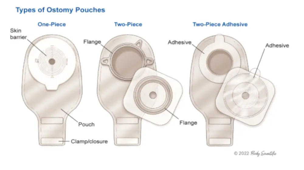 Pernah Dengar Kantung kolostomi? Bukan Sekadar Kantong, Kenali Fakta, Peran dan Jenis Yang Perlu Kamu Tahu