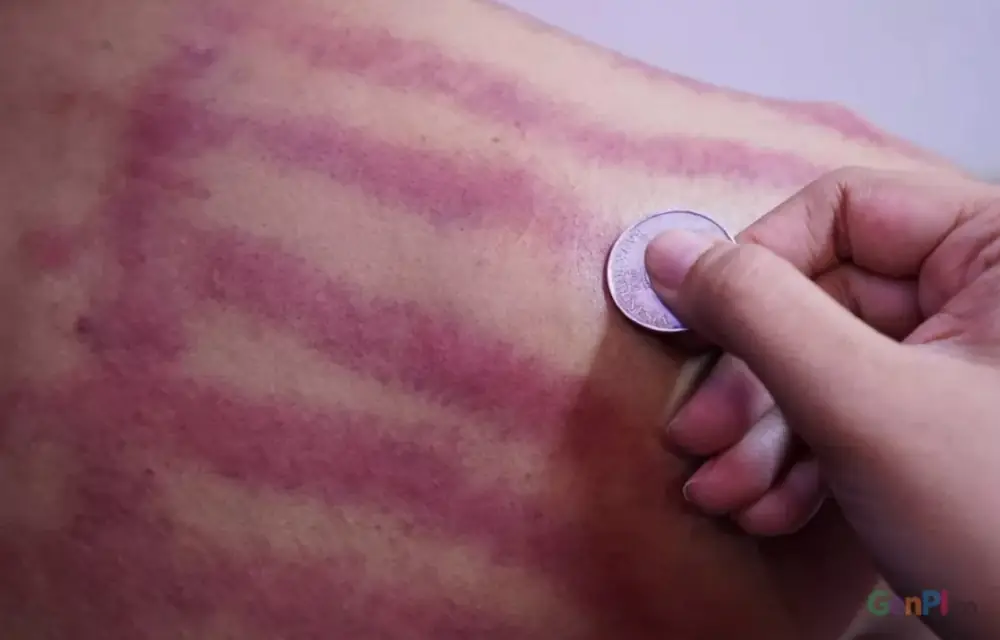 Masuk Angin dan Kerokan, Apa Kata Dunia Medis Tentang Dua Hal yang Tak Terpisahkan Ini?