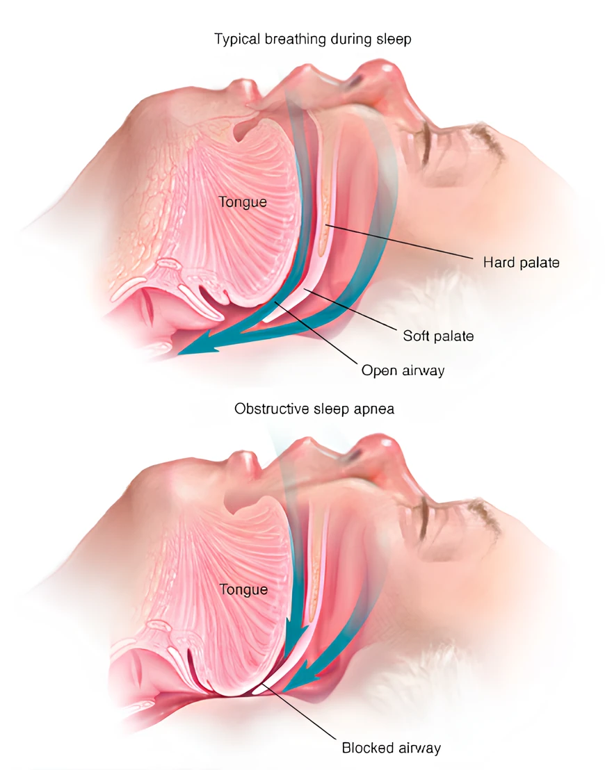 Apa Hubungan Sleep Apnea dan Tekanan Darah Tinggi? Kenali Kaitannya dan Peran CPAP