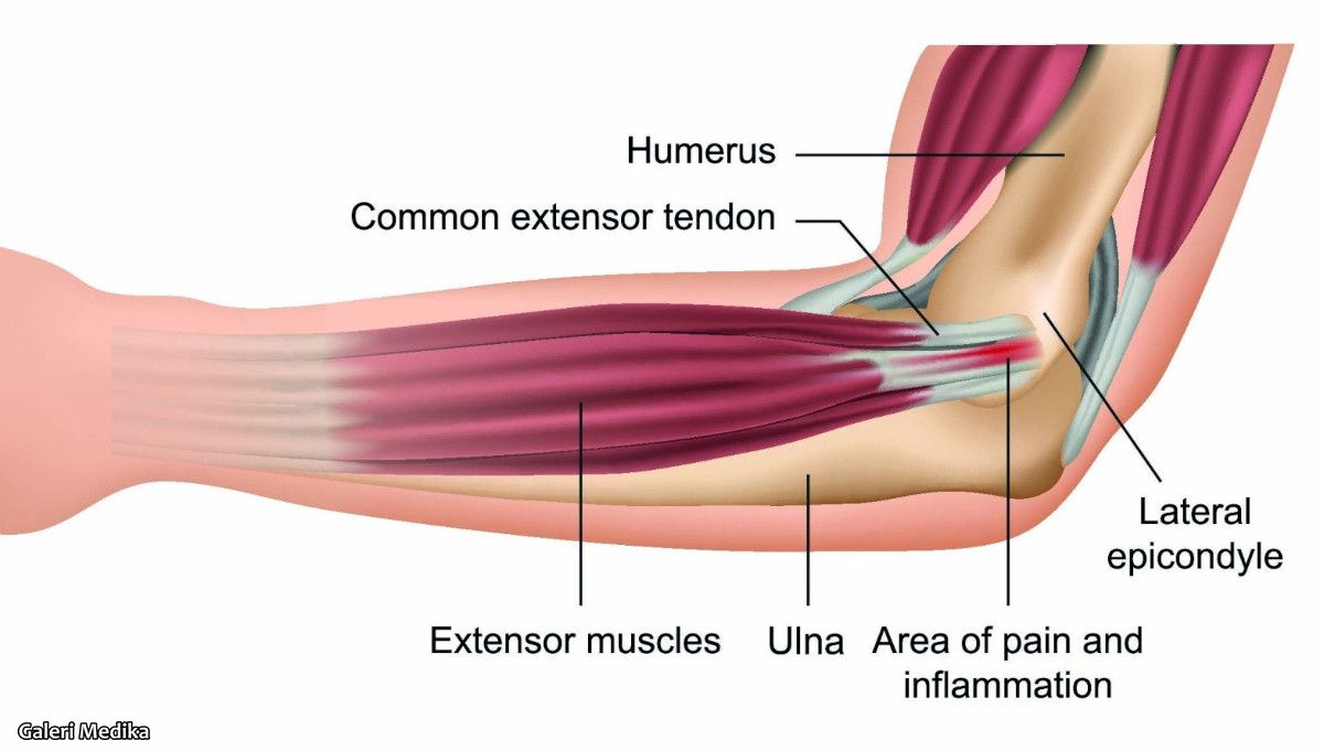 Gangguan Tenis Elbow